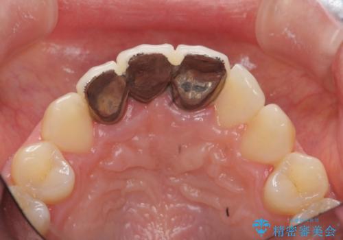 歯ぐきの凹みが気になる　前歯部ブリッジ審美改善の治療前