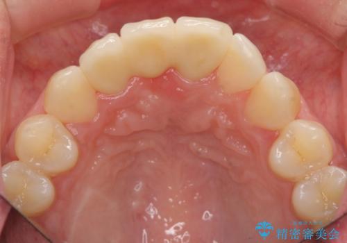 歯ぐきの凹みが気になる　前歯部ブリッジ審美改善の治療後