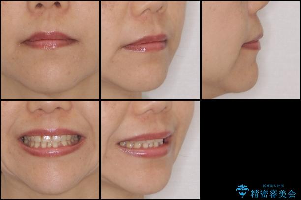前歯のでこぼこをきれいに　インビザラインによる矯正治療の治療前（顔貌）
