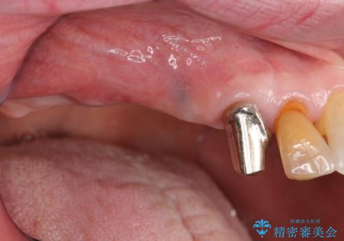 臼歯の遊離端欠損　インプラント補綴の治療前