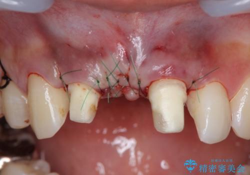 歯ぐきの凹みが気になる　前歯部ブリッジ審美改善の治療中