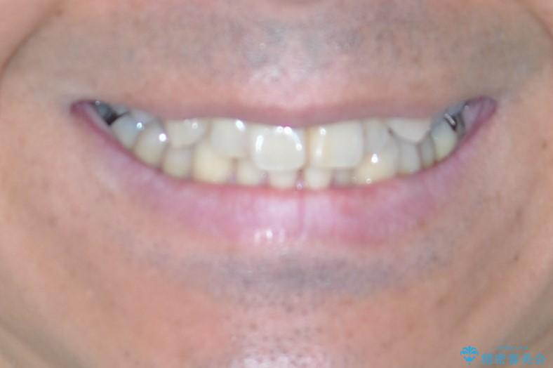 八重歯のワイヤー矯正　古典的なメタルの装置の一例の治療前（顔貌）