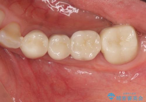 奥歯　インプラントによる咬合回復の治療後