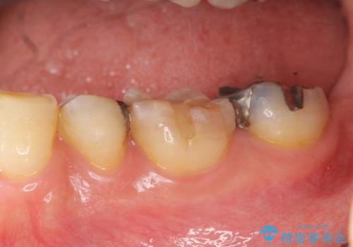 銀歯の下に再発した虫歯 　セラミックインレー修復の治療前