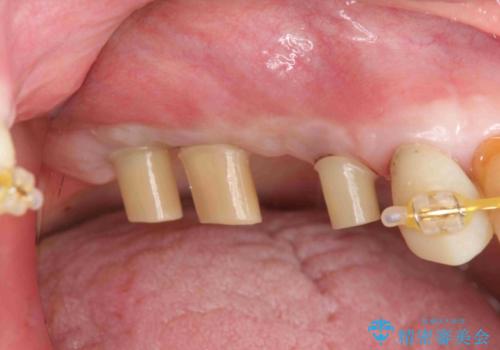 臼歯の遊離端欠損　インプラント補綴の治療中