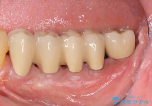 [歯周病治療]  再生療法で歯を残す②の治療後