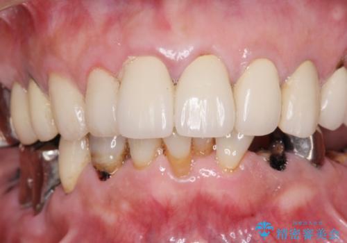 虫歯だらけの口腔内　全顎治療の治療前