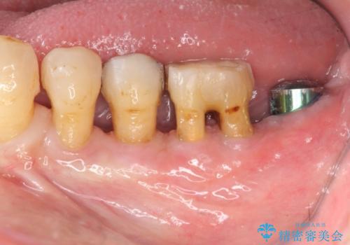 [歯周病治療]  再生療法で歯を残す②の治療前