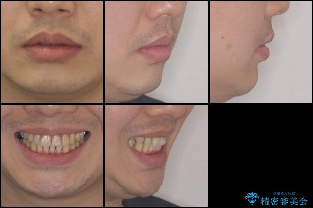 上下前歯のでこぼこをきれいに　インビザラインによる歯列矯正の治療後（顔貌）