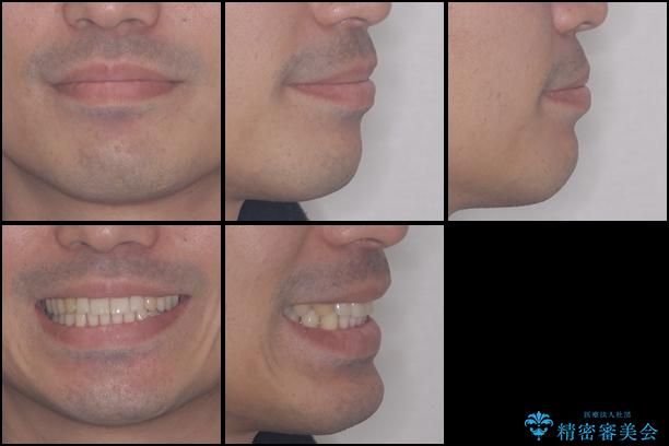 インビザラインによる矯正治療と銀歯の審美治療の治療後（顔貌）