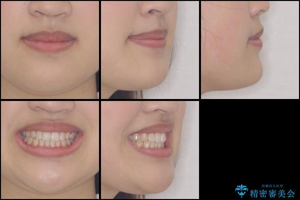 ワイヤー矯正とマウスピース矯正を併用して、短期間で歯列矯正の治療後（顔貌）