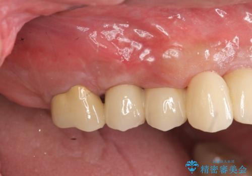 [天然歯の遠心移動]  適切なインプラントー歯牙距離を確保するの治療後