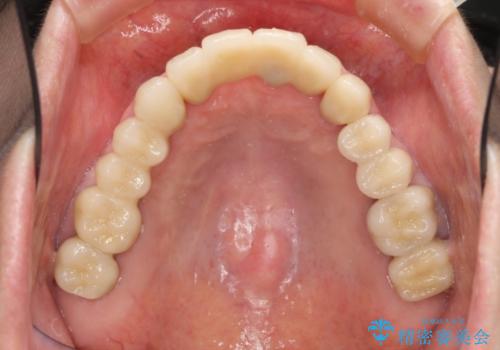虫歯だらけの口腔内　全顎治療の治療後
