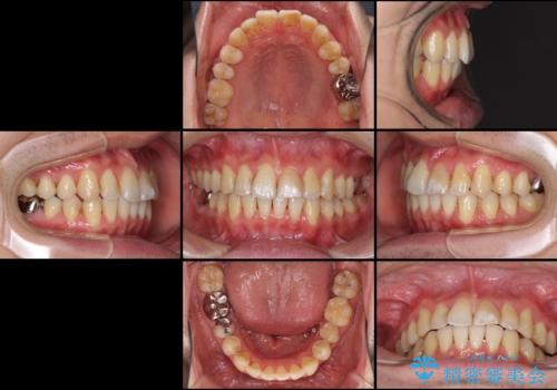 上下前歯のでこぼこをきれいに　インビザラインによる歯列矯正の治療後
