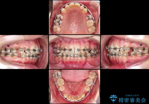 出っ歯を治したい　メタル装置による抜歯矯正の治療中