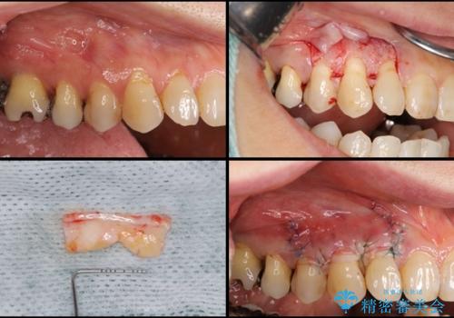 歯根が露出している歯の歯肉再生　根面被覆術の治療中