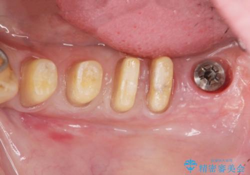 [歯周病治療]  再生療法で歯を残す②の治療中