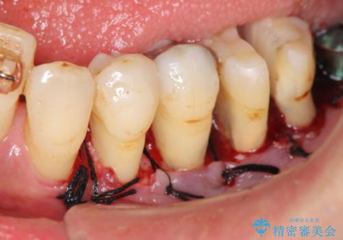 [歯周病治療]  再生療法で歯を残す①の治療後