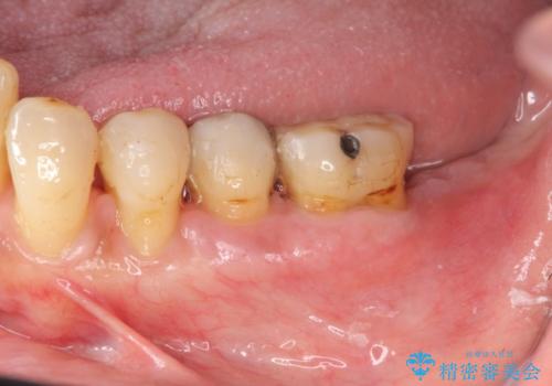 [歯周病治療]  再生療法で歯を残す①の治療後