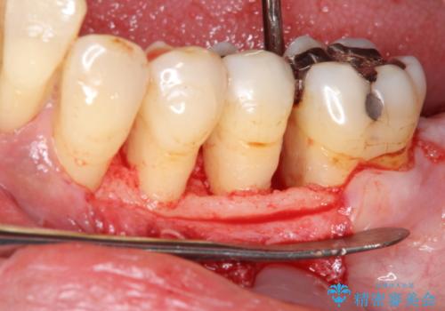 [歯周病治療]  再生療法で歯を残す①の治療中
