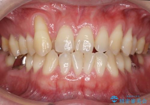 受け口、八重歯　変則的な抜歯の治療前
