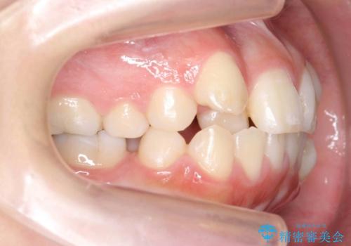 20代女性　八重歯をきれいに、前歯のがたがたの治療前