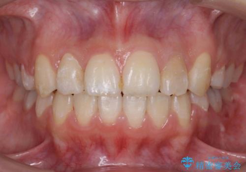 20代女性　八重歯をきれいに、前歯のがたがたの治療後