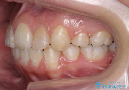 20代女性　八重歯をきれいに、前歯のがたがたの治療後