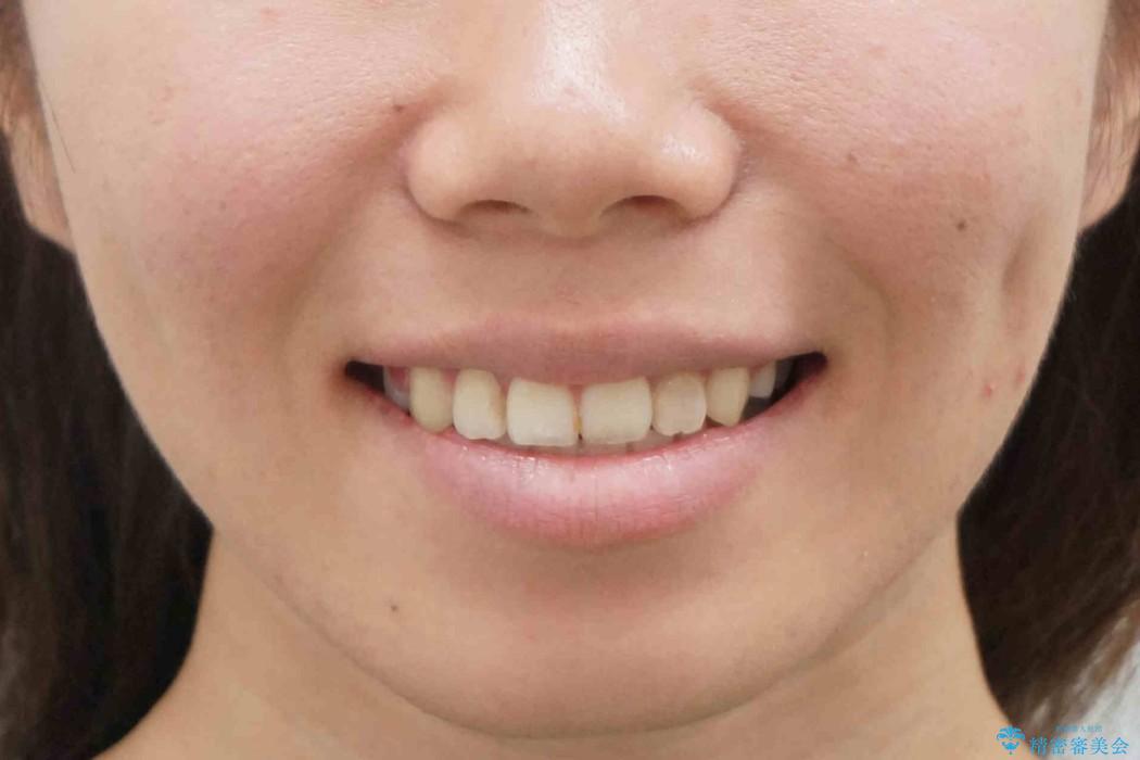 20代女性　八重歯をきれいに、前歯のがたがたの治療後（顔貌）
