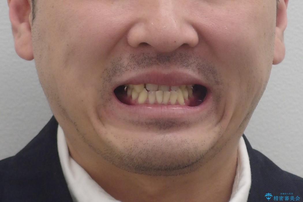 受け口、八重歯　変則的な抜歯の治療前（顔貌）