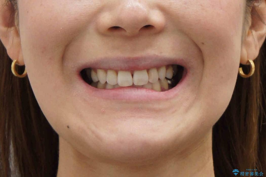 前歯を下げたい　矯正治療+つめもののやりかえの治療後（顔貌）