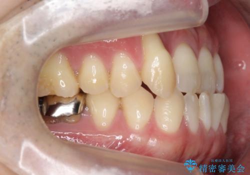 受け口、八重歯　変則的な抜歯の治療前