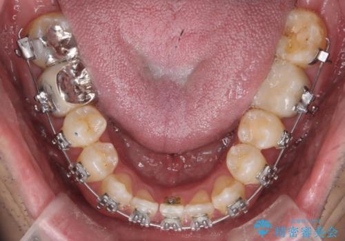 受け口、八重歯　変則的な抜歯の治療中