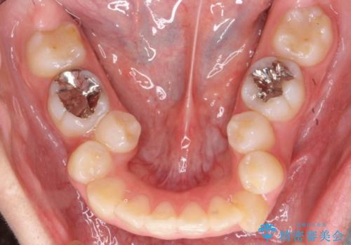 20代女性　八重歯をきれいに、前歯のがたがたの治療前