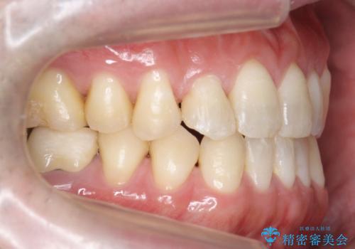 受け口、八重歯　変則的な抜歯の治療後