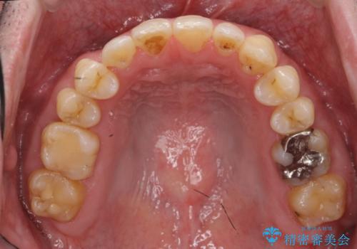 受け口、八重歯　変則的な抜歯の治療後
