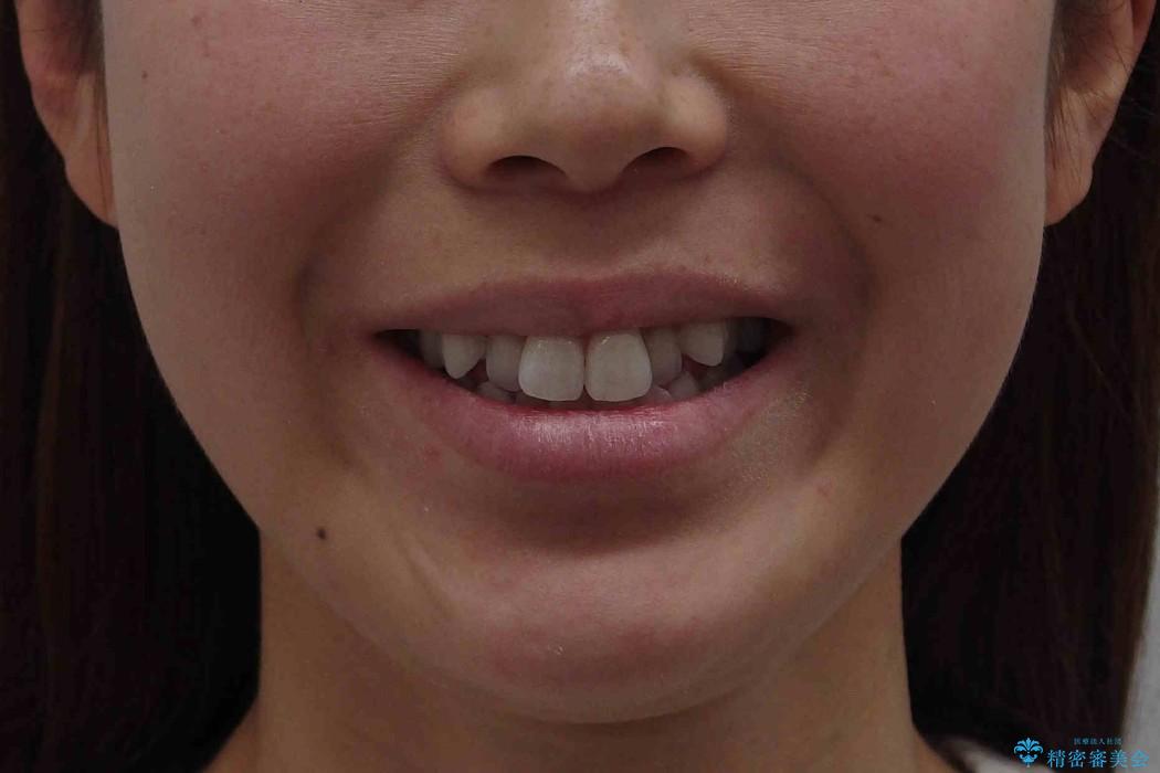 前歯を下げたい　矯正治療+つめもののやりかえの治療前（顔貌）