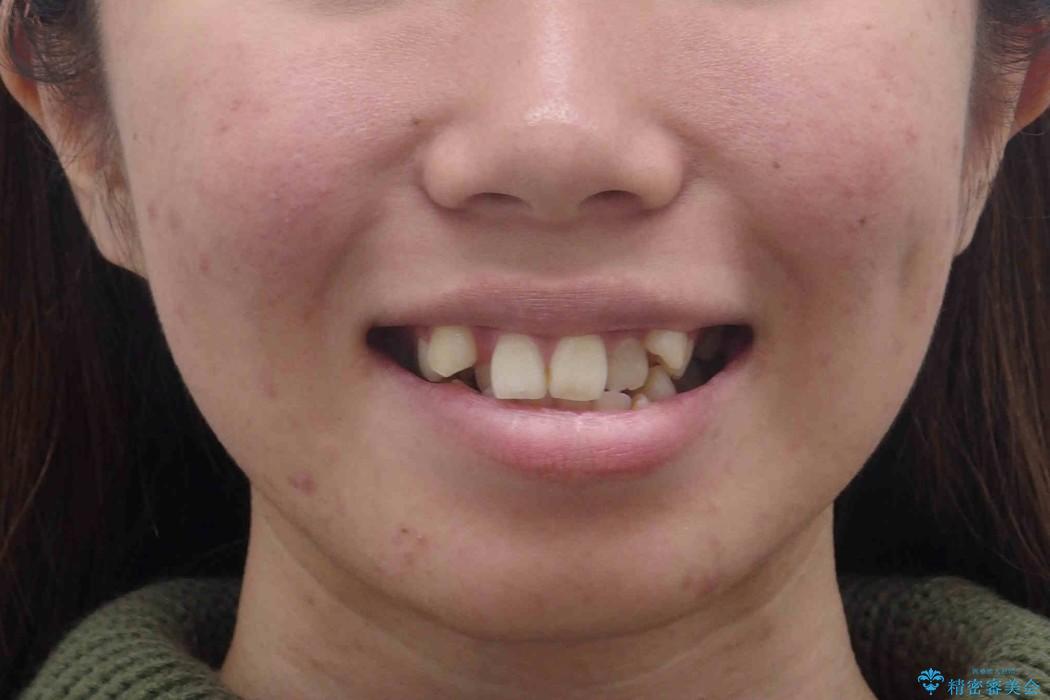 20代女性　八重歯をきれいに、前歯のがたがたの治療前（顔貌）