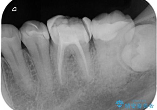 割れた奥歯の再修復　土台からの治療の治療前
