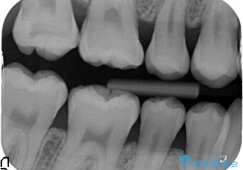 20代男性 上の奥歯のレジン修復下の虫歯　の治療前