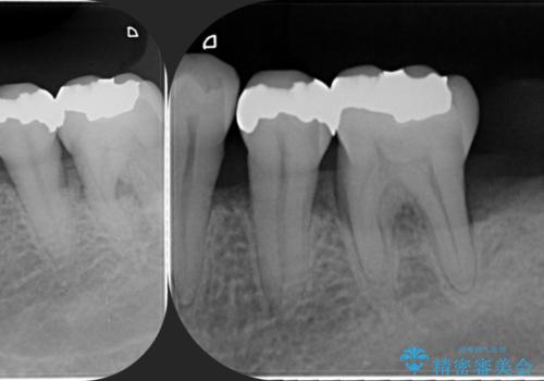[歯周病治療]  再生療法で歯を残す①の治療前