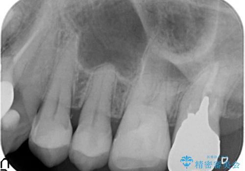 60代女性　銀歯の下が虫歯　隣も虫歯の治療後
