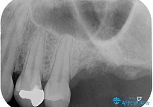 上顎臼歯部におけるインプラント治療の治療中