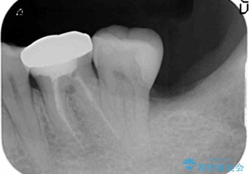 40代女性　親知らずを放置　手前の歯が虫歯にの治療後
