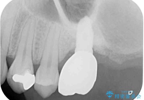 上顎臼歯部におけるインプラント治療の治療後
