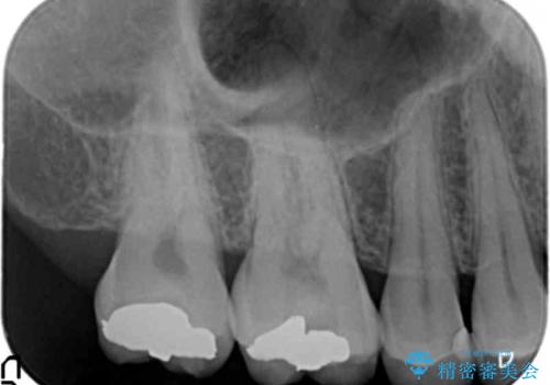 40代男性　銀歯を全て白くしたい　マウスピース矯正も希望の治療前
