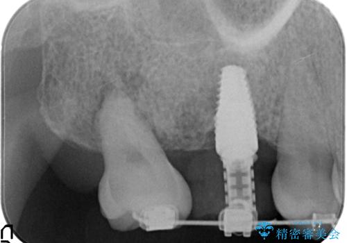 インプラントと部分矯正による奥歯のかみ合わせの改善の治療中