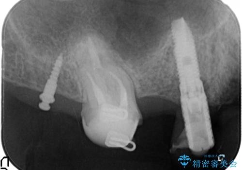 [天然歯の遠心移動]  適切なインプラントー歯牙距離を確保するの治療前
