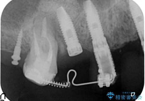 [天然歯の遠心移動]  適切なインプラントー歯牙距離を確保する