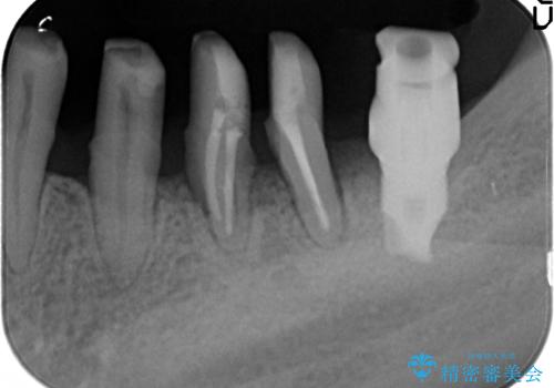 [歯周病治療]  再生療法で歯を残す②の治療中